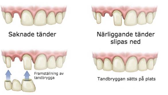 bro tandbrygga varberg tandläkare